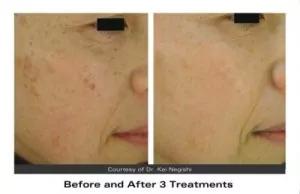 Age spot removal Age spot removal
