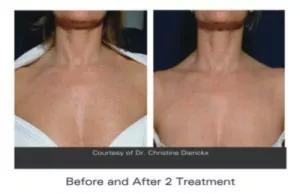 Age spot removal Age spot removal