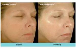 Skin rejuvenation Skin rejuvenation