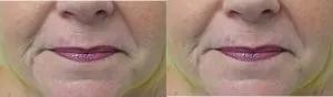 cool-laser-before-after-300×88-1 cool-laser-before-after-300×88-1