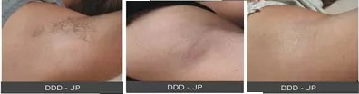 laserhairremoval laserhairremoval