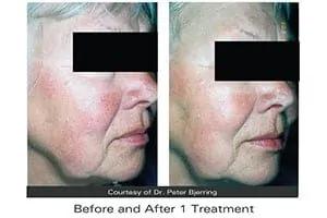Rosacea treatment Rosacea treatment