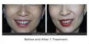 Skin rejuvenation Skin rejuvenation