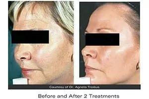 Skin rejuvenation Skin rejuvenation