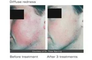 Thread vein removal Thread vein removal