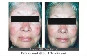 Thread vein removal Thread vein removal