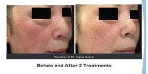 Blood spot removal Blood spot removal